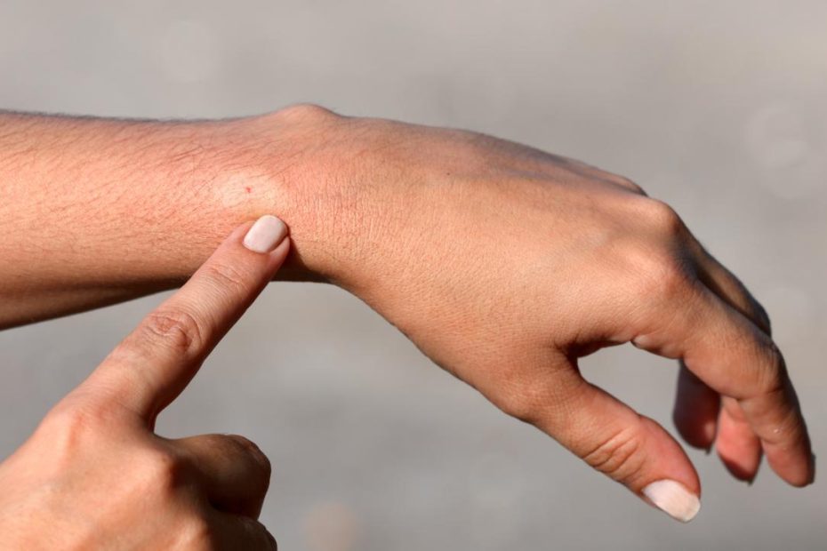 Bee Sting Allergy: Symptoms, Causes, And Treatment